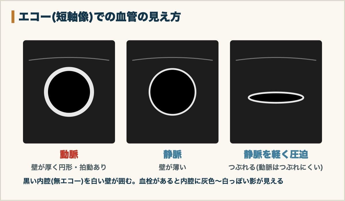 エコーの短軸像での動脈と静脈の見え方