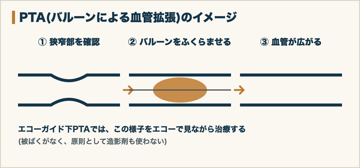 PTA(バルーンによる血管拡張)のイメージ