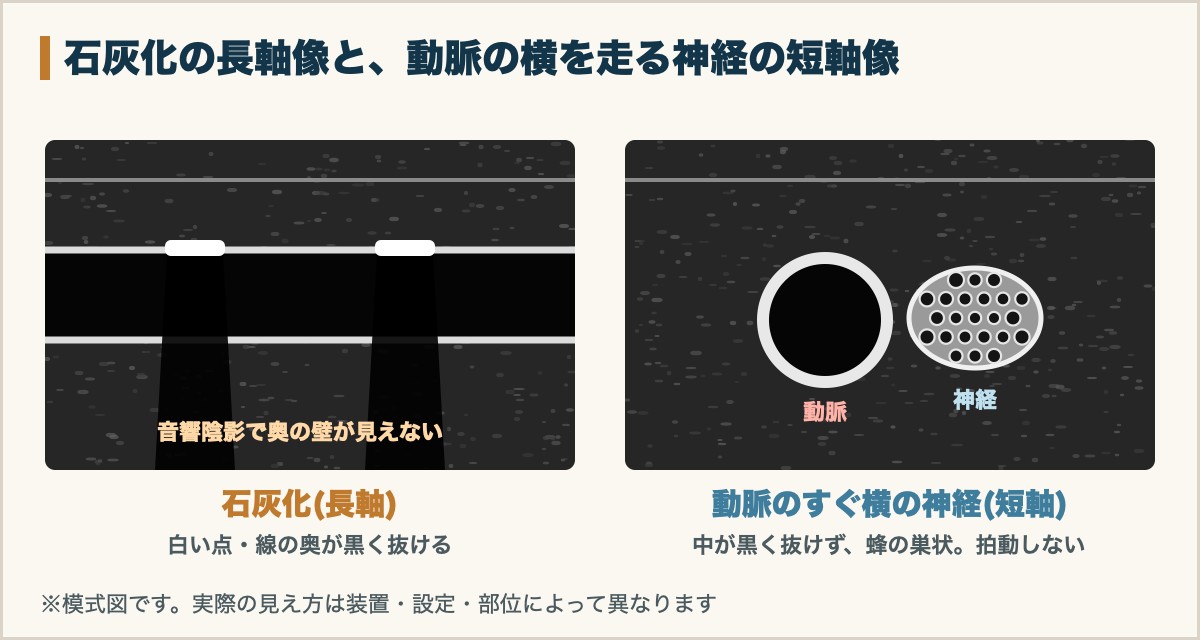 長軸像で見た石灰化と、動脈の横を走る神経の短軸像の模式図