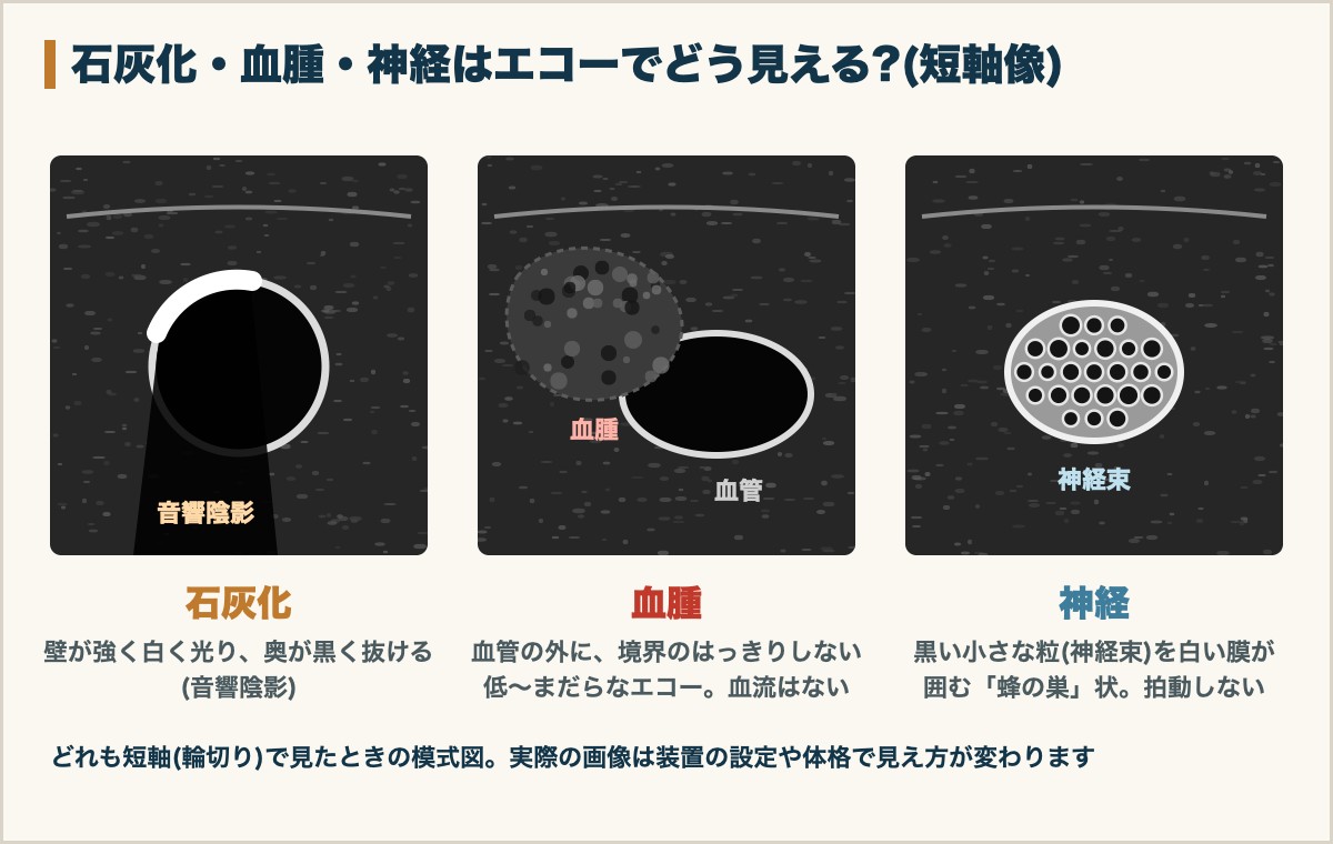石灰化・血腫・神経のエコー短軸像での見え方の模式図