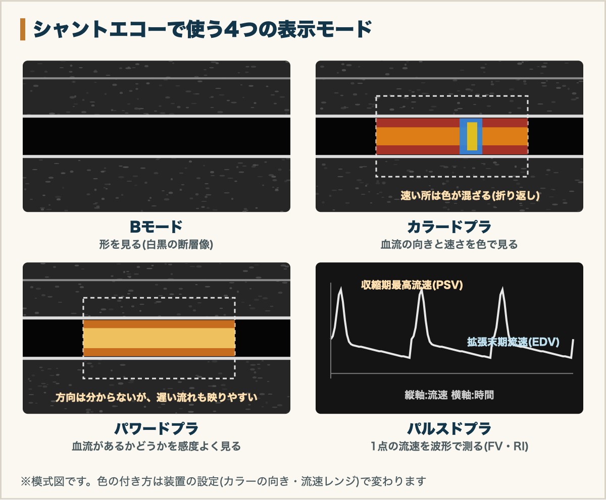 シャントエコーで使う4つの表示モード(Bモード・カラードプラ・パワードプラ・パルスドプラ)の模式図