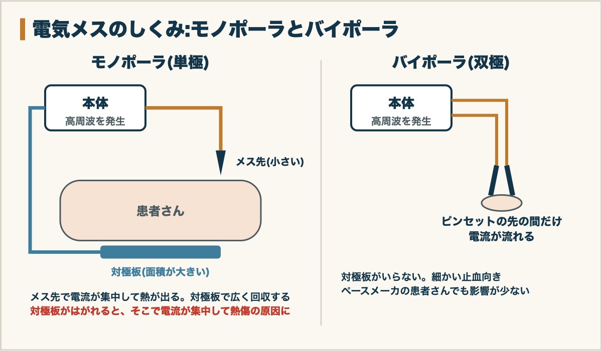 電気メスのしくみ:モノポーラとバイポーラ